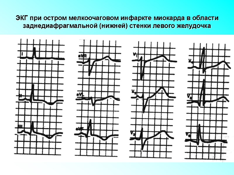 ЭКГ при остром мелкоочаговом инфаркте миокарда в области заднедиафрагмальной (нижней) стенки левого желудочка